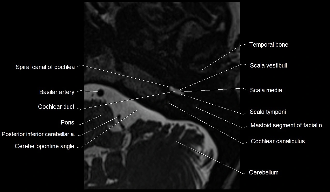 Internal auditory canal (IAC) axial cross sectional anatomy image 4.webp